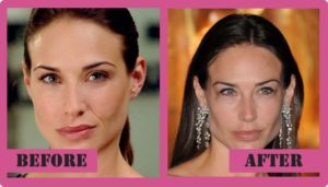 claire forlani facelift