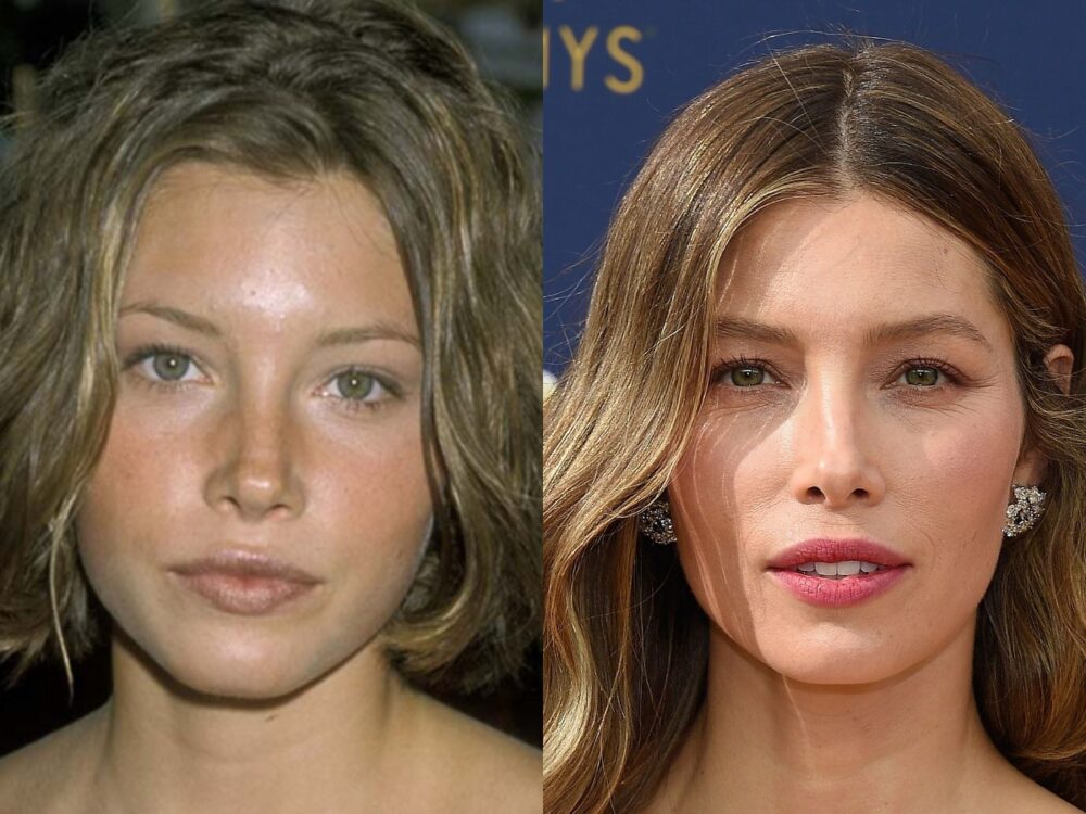 Jessica Biel Plastic Surgery - With Before And After Photos