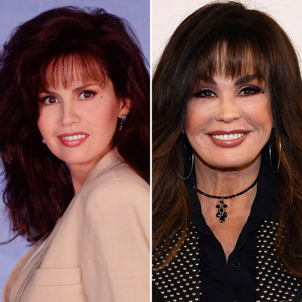 Marie Osmond Plastic Surgery With Before And After Photos