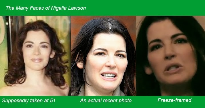 nigella lawson plastic surgery