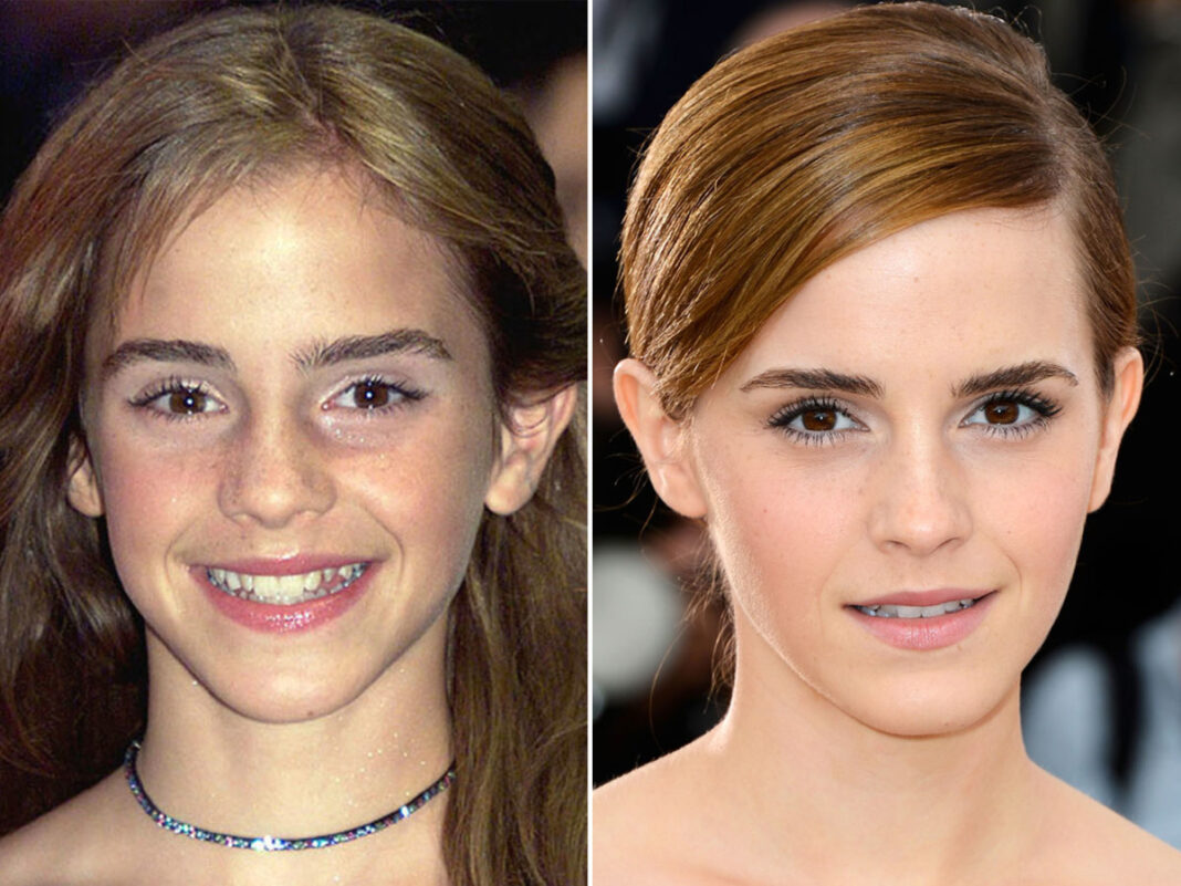 Emma Watson Plastic Surgery - With Before And After Photos.