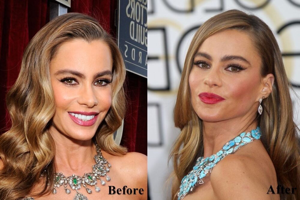 Sofia Vergara Plastic Surgery - With Before And After Photos