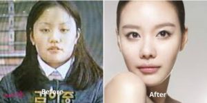 kim ah joong plastic surgery