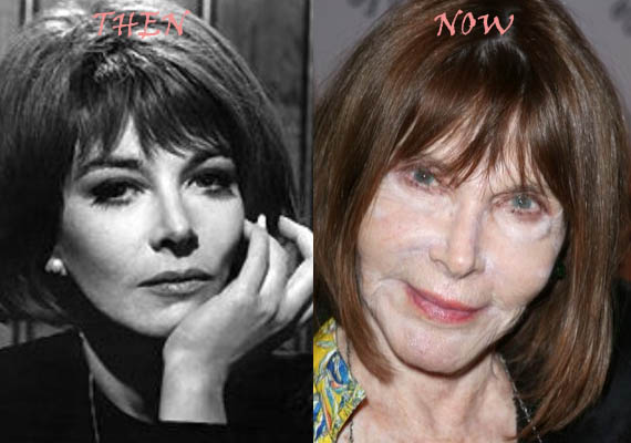Lee Grant Plastic Surgery - With Before And After Photos