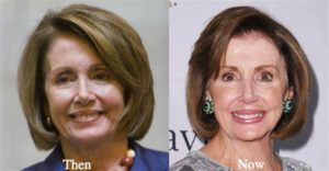 nancy pelosi plastic surgery