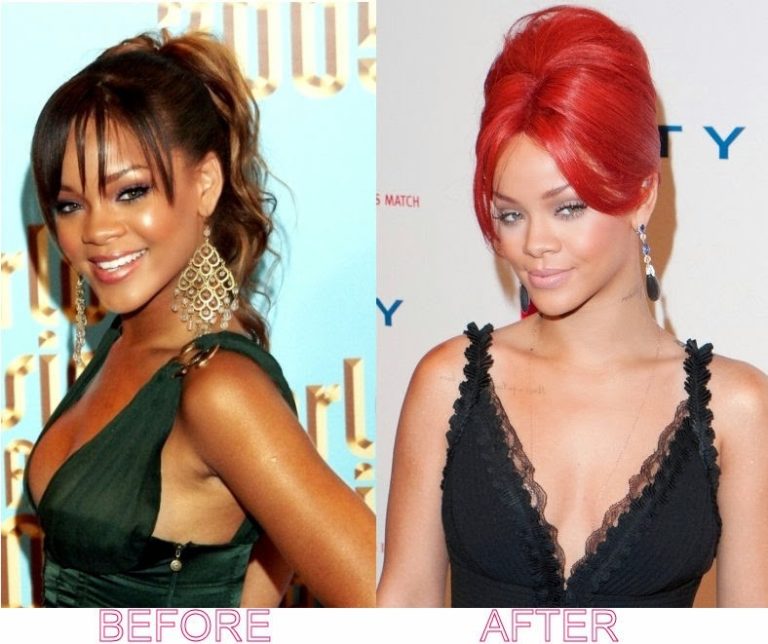 Rihanna Plastic Surgery With Before And After Photos
