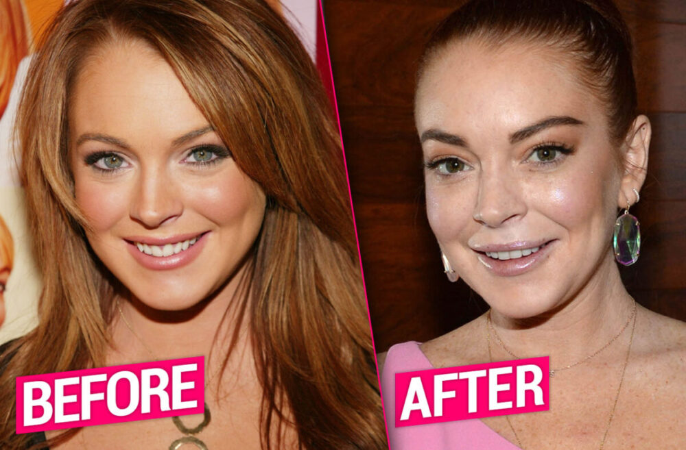 Lindsay Lohan Plastic Surgery - With Before And After Photos.