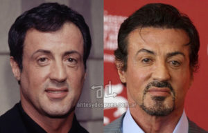 sylvester stallone plastic surgery